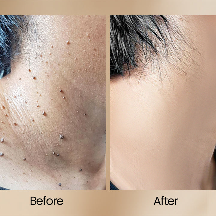 1+1 GRATIS | ClearSkin™ | Bienengift Warzenentfernung Spray