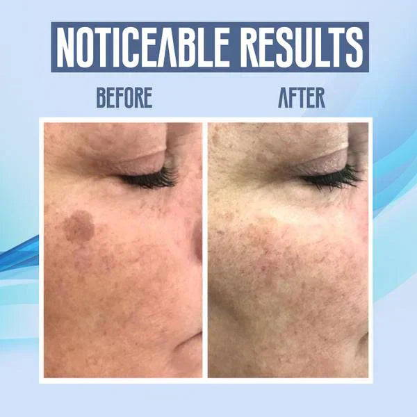 SpotClear™ | Dark Spot Vanisher in nur wenigen Wochen