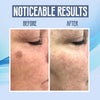 SpotClear™ | Dark Spot Vanisher in nur wenigen Wochen