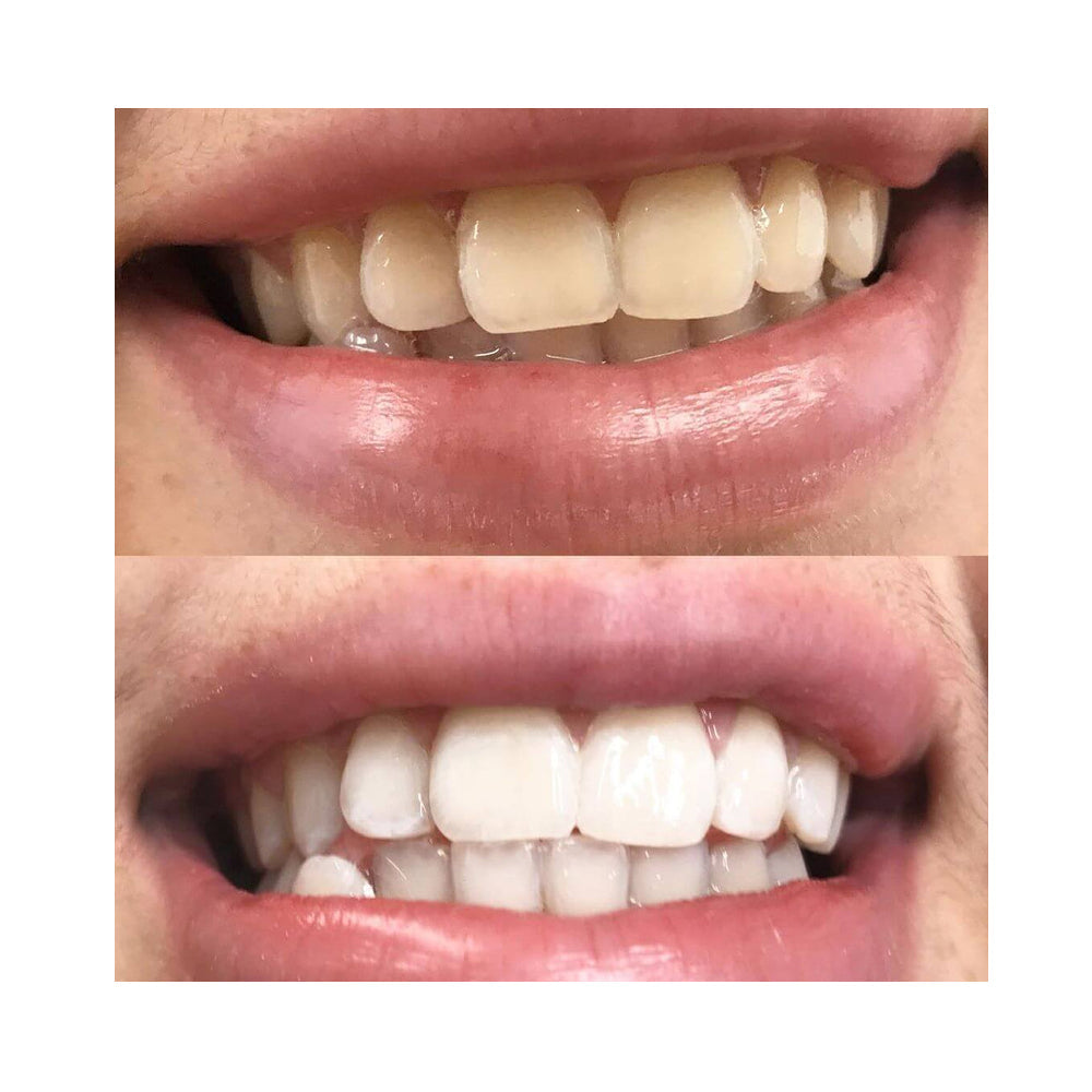 Lumière Pro™ – Zahnaufhellungsset