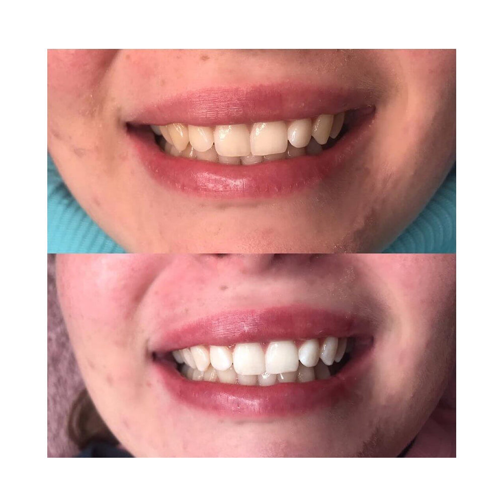 Lumière Pro™ – Zahnaufhellungsset