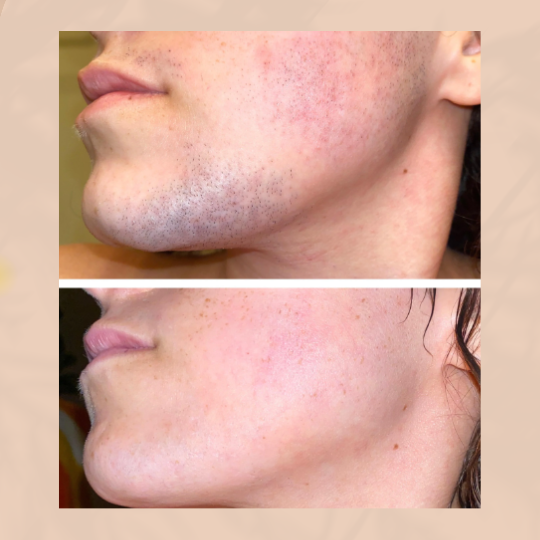 BareSmooth™ | Enthaarungscreme für Frauen