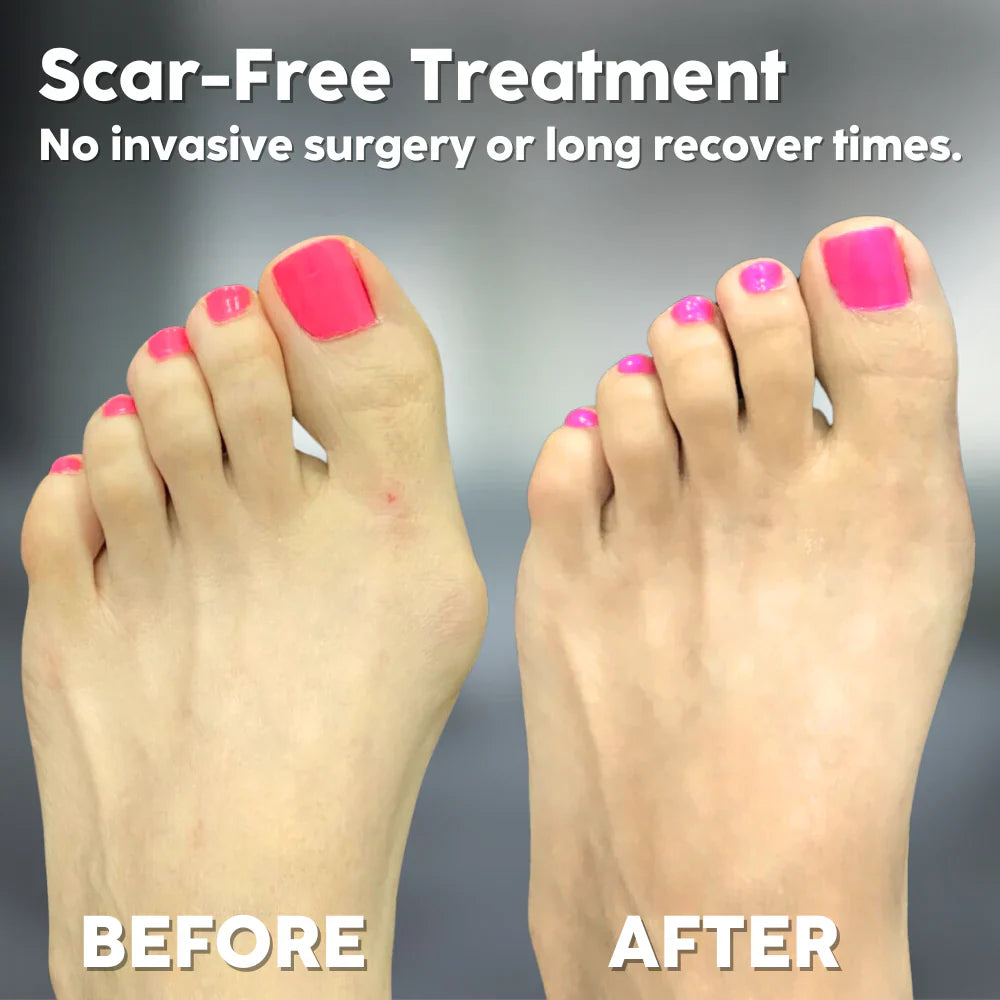 ToeAlign™ – Effektiver Hallux-Valgus-Korrektor